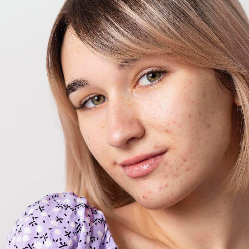 acne breakout