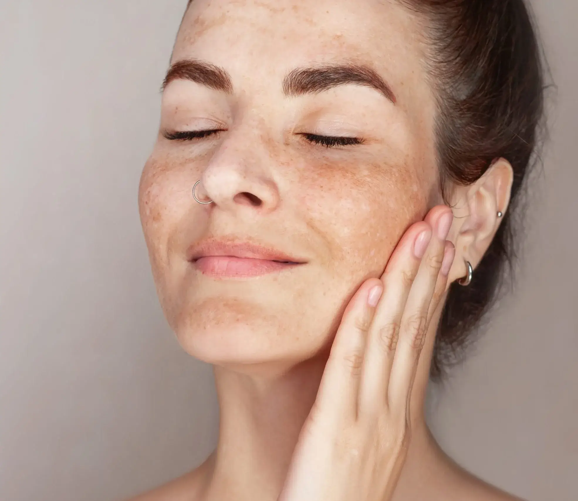 Melasma scaled e1760455246100 1