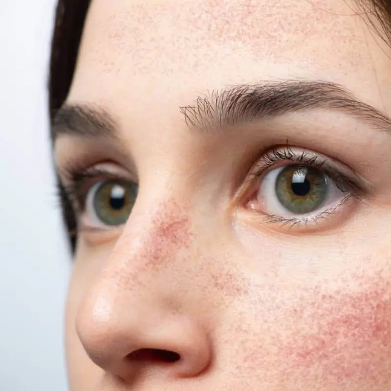 sensitive skin redness